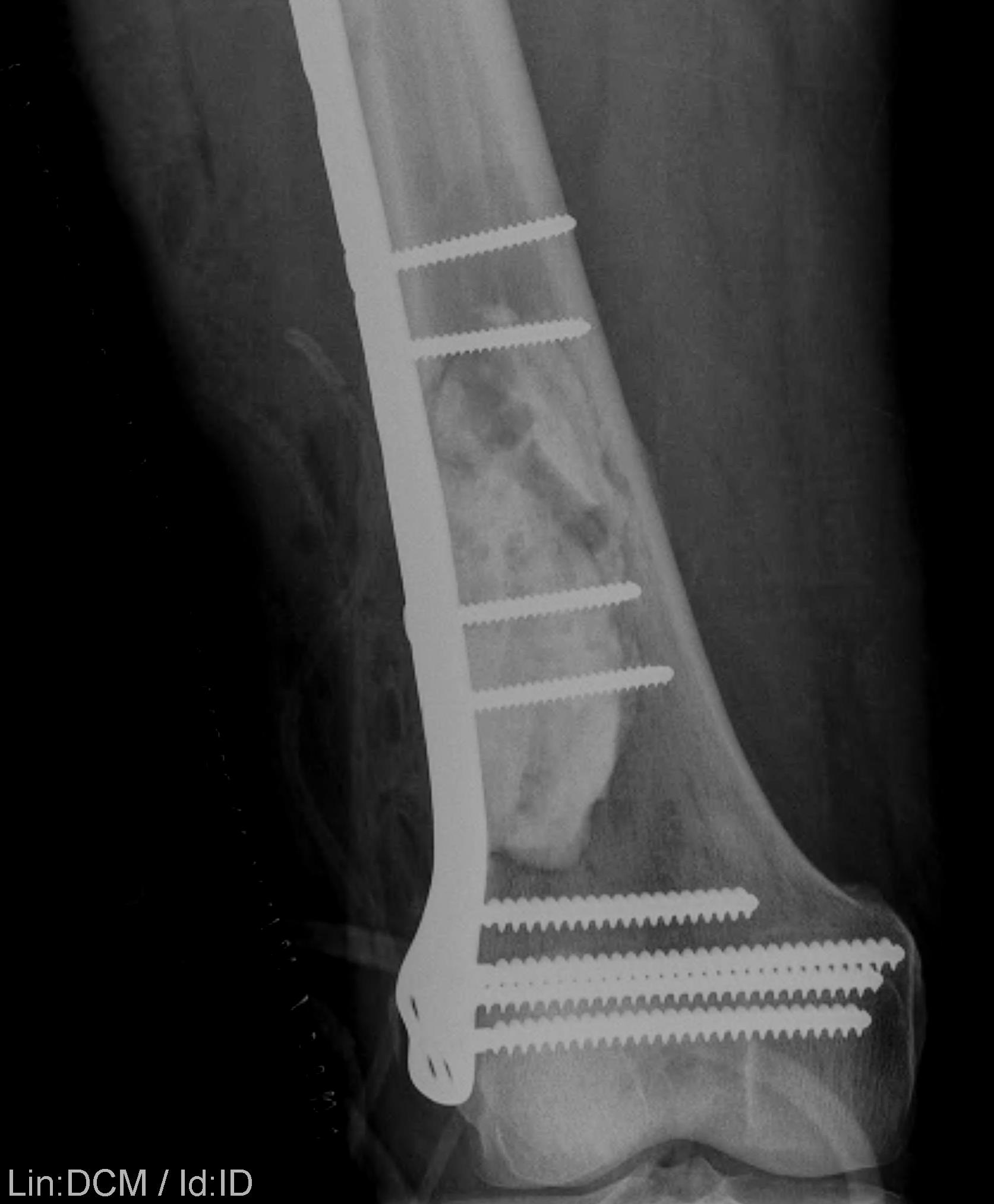 Metastasis Distal Femur Plate and PMMA